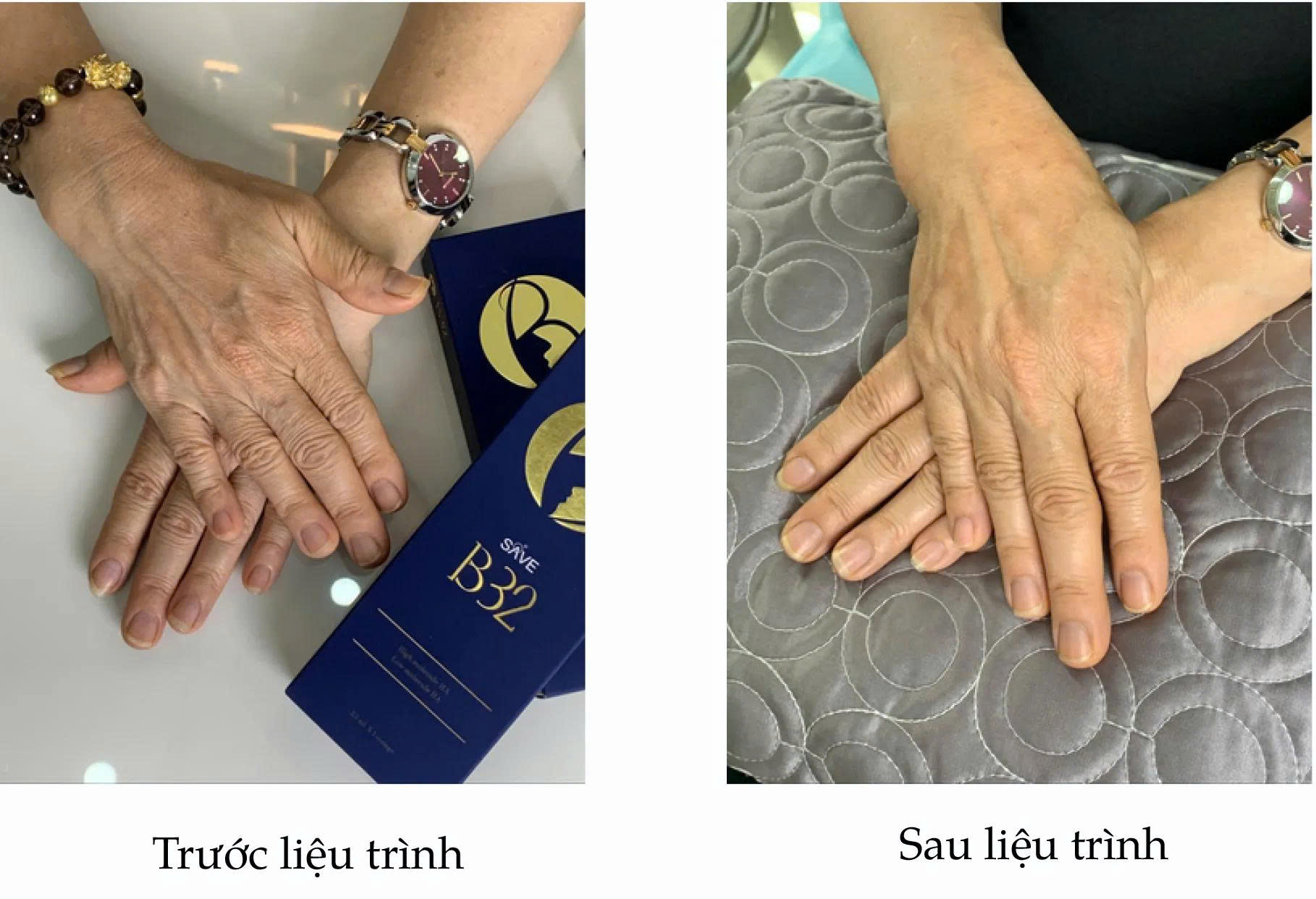 Lieu-Trinh-Tiem-B-A-P-SAVE-32-SP-Dinh-Cao-Tre-Hoa-Mo-Mo-Sinh-Hoc-1.jpg?v=1775102903