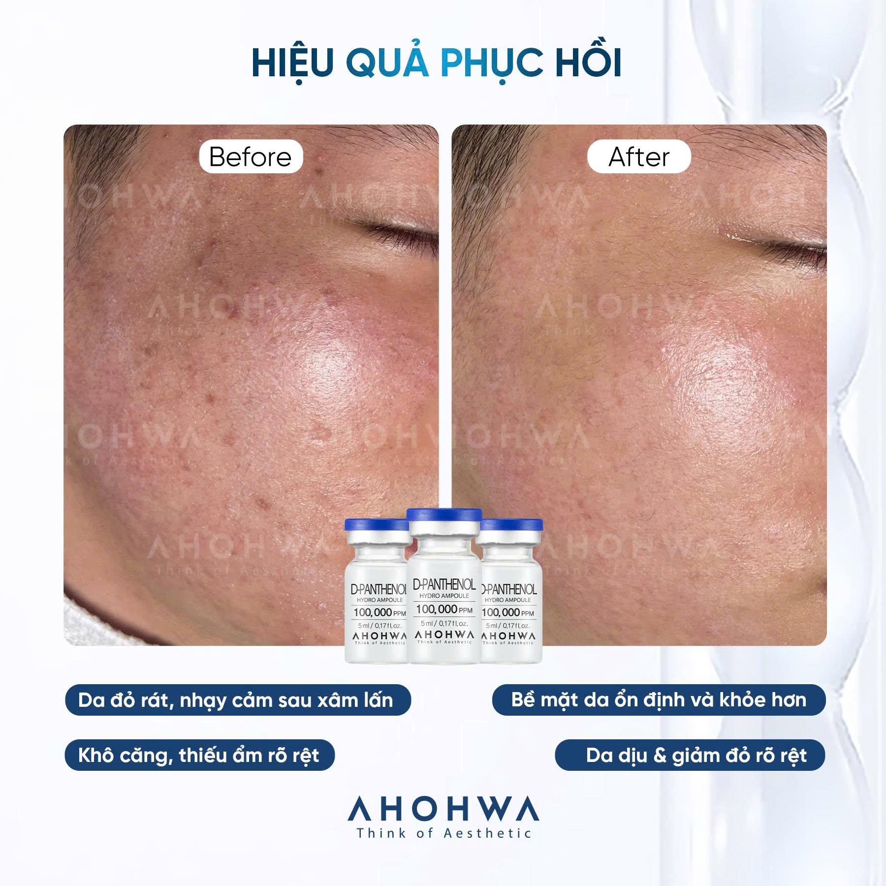 Tế bào gốc kháng viêm phục hồi tái tạo da nhạy cảm sau xâm lấn Ahohwa D-Panthenol Hydro Ampoule 4.jpg