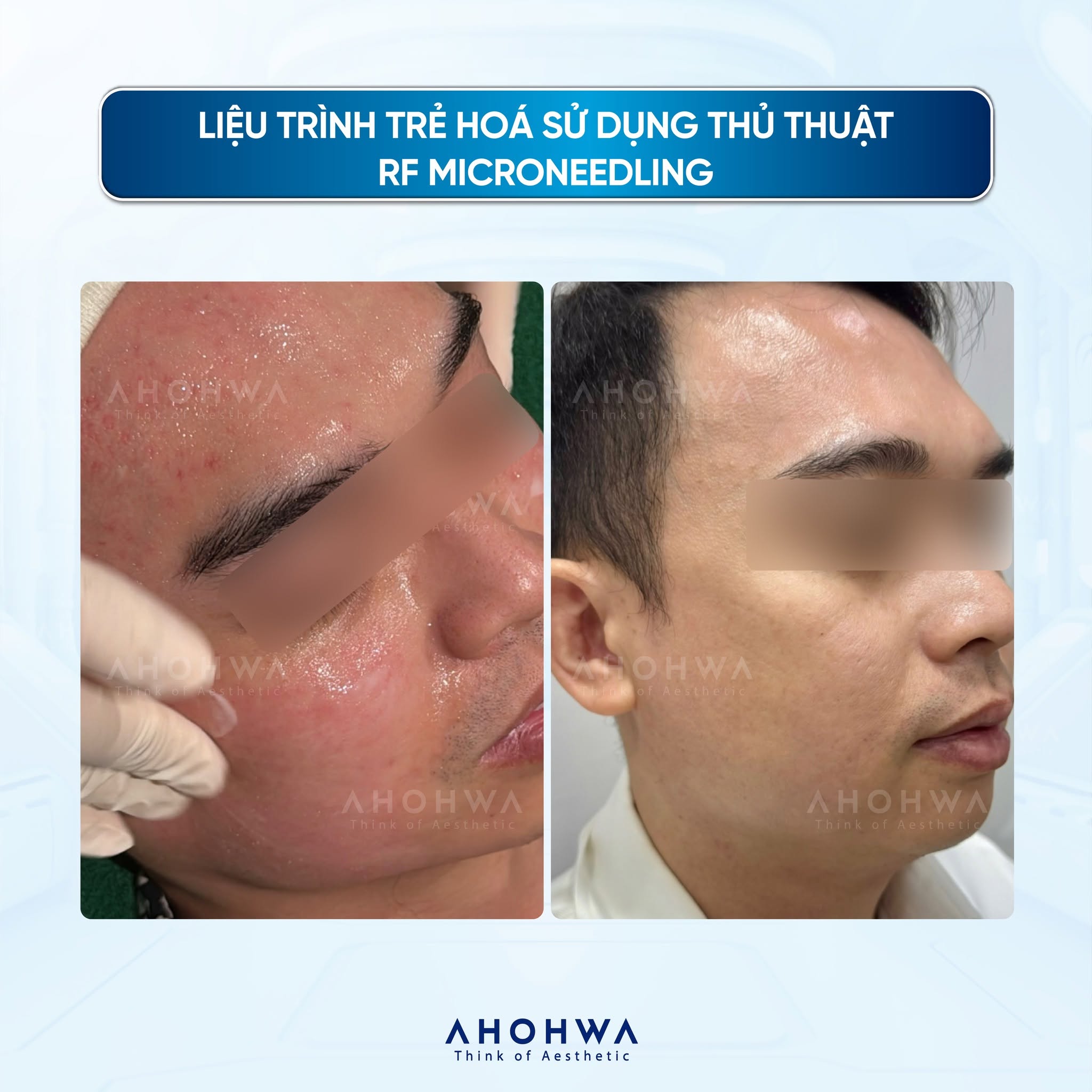 Tinh chất tăng trưởng tế bào gốc Ahohwa SRGF H1 Reset Ampoule 6.jpg