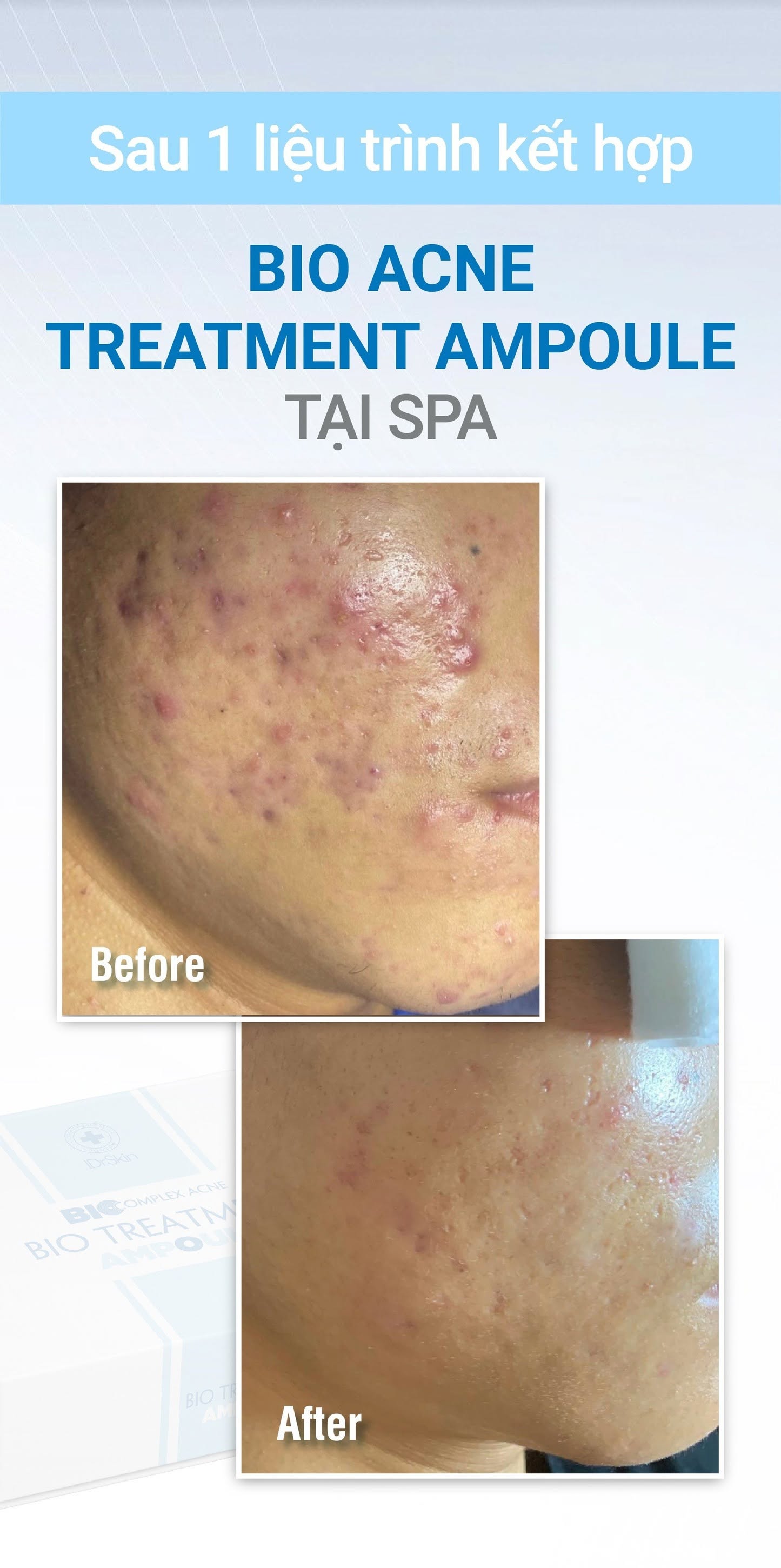 Tinh chất trị mụn Idr.Skin Bio Acne Treatment Ampoule 5.jpg