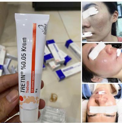 Tretin-Krem-0-05-30g-Tho-Nhi-Ky-Kem-Tretinoin-Tri-Mun-Mo-Tham-Chong-Lao-Hoa.jpg?v=1781233924