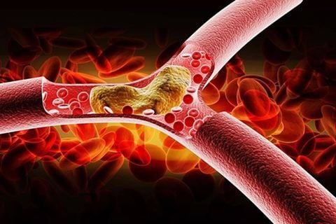 Những điều cần biết về bệnh mỡ máu và phương pháp hỗ trợ điều trị hiệu quả