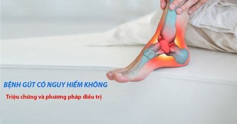 Bệnh gút có nguy hiểm không? Những biến chứng hay gặp