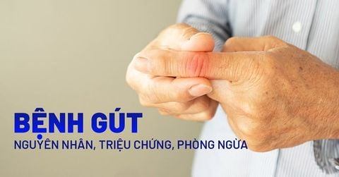 Các nguyên nhân gây ra bệnh gút và biện pháp phòng ngừa