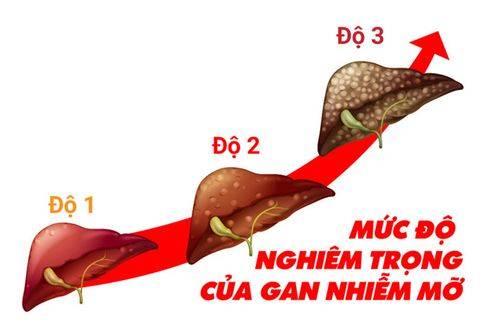 Gan nhiễm mỡ có nguy hiểm không? Báo động đỏ cho sức khỏe
