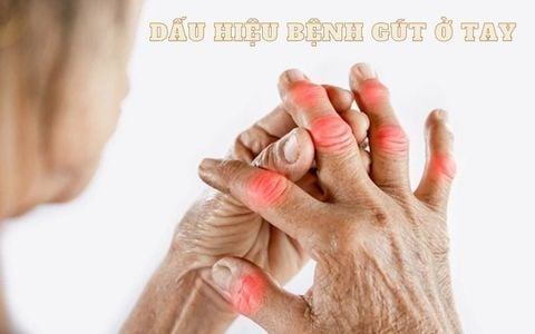 Nhận biết sớm dấu hiệu bệnh gút ở tay