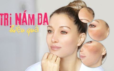 Cách trị nám hiệu quả: Từ phương pháp tự nhiên đến công nghệ cao