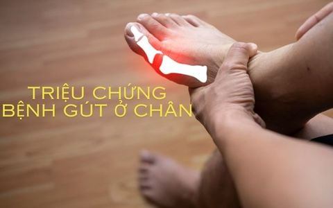 Triệu chứng bệnh gút ở chân, phòng ngừa và điều trị