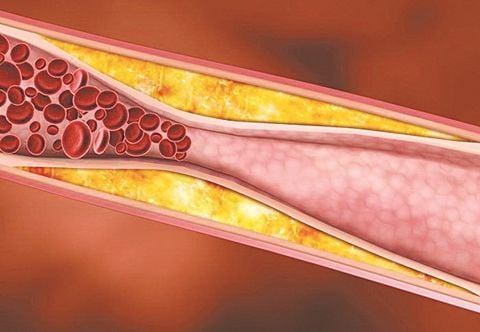 Tác hại của mỡ máu cao và các biện pháp hạn chế tăng mỡ máu