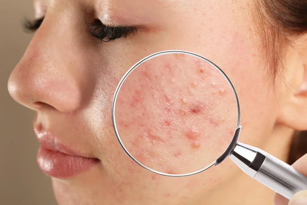Chăm Sóc Da Tuổi Dậy Thì Để Ngăn Ngừa Mụn