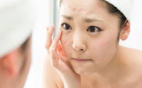 Nhầm lẫn phổ biến khi dùng thuốc bổ mát gan trị mụn