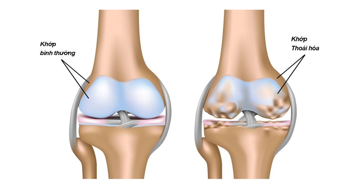 Cách Phòng Và Điều Trị Đau Nhức Thoái Hóa Khớp