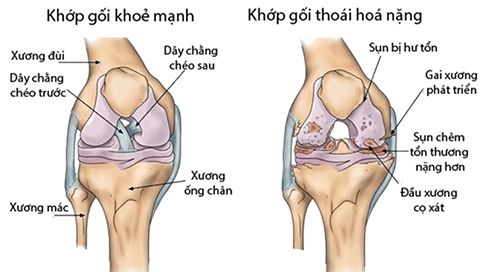 Đau Nhức Xương Khớp Uống Thuốc Gì