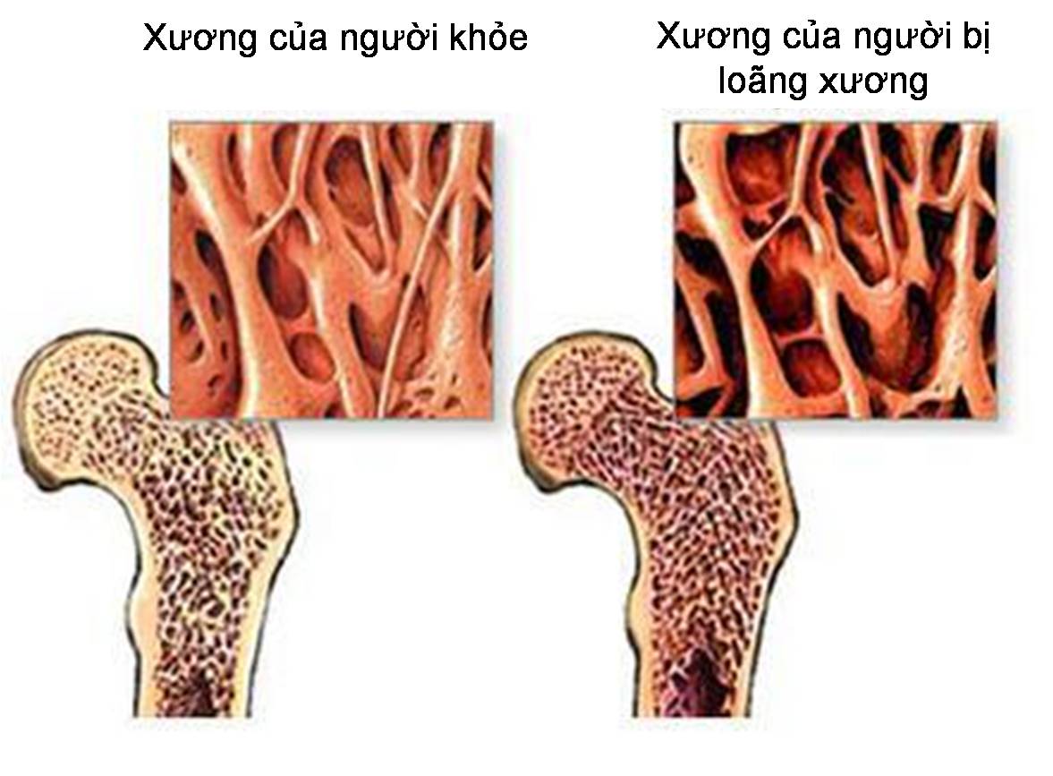 thực phẩm chức năng canxi