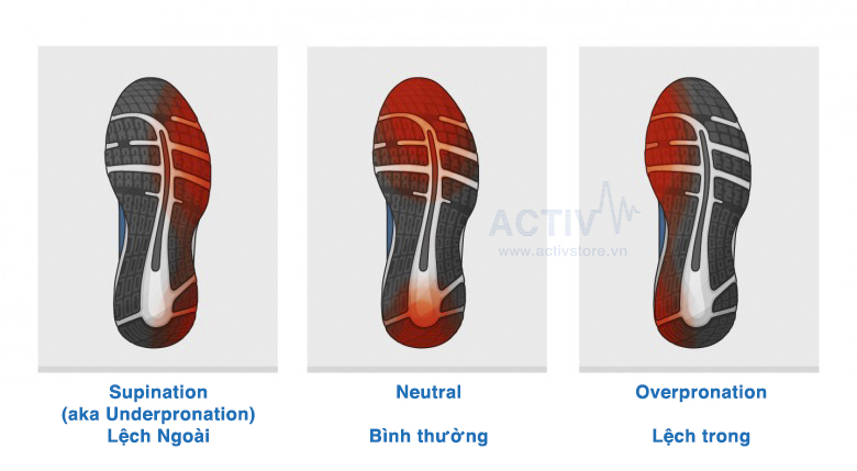 overpronation