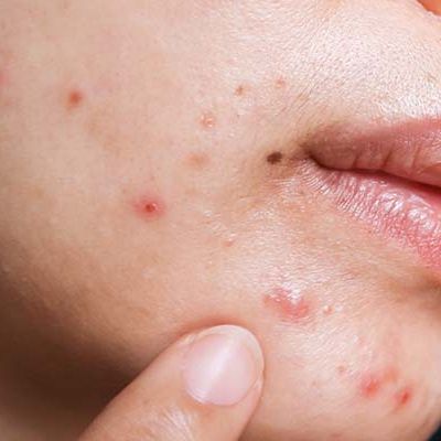 Cách Làm Xẹp Mụn Bọc Tại Nhà Không Cần Nặn