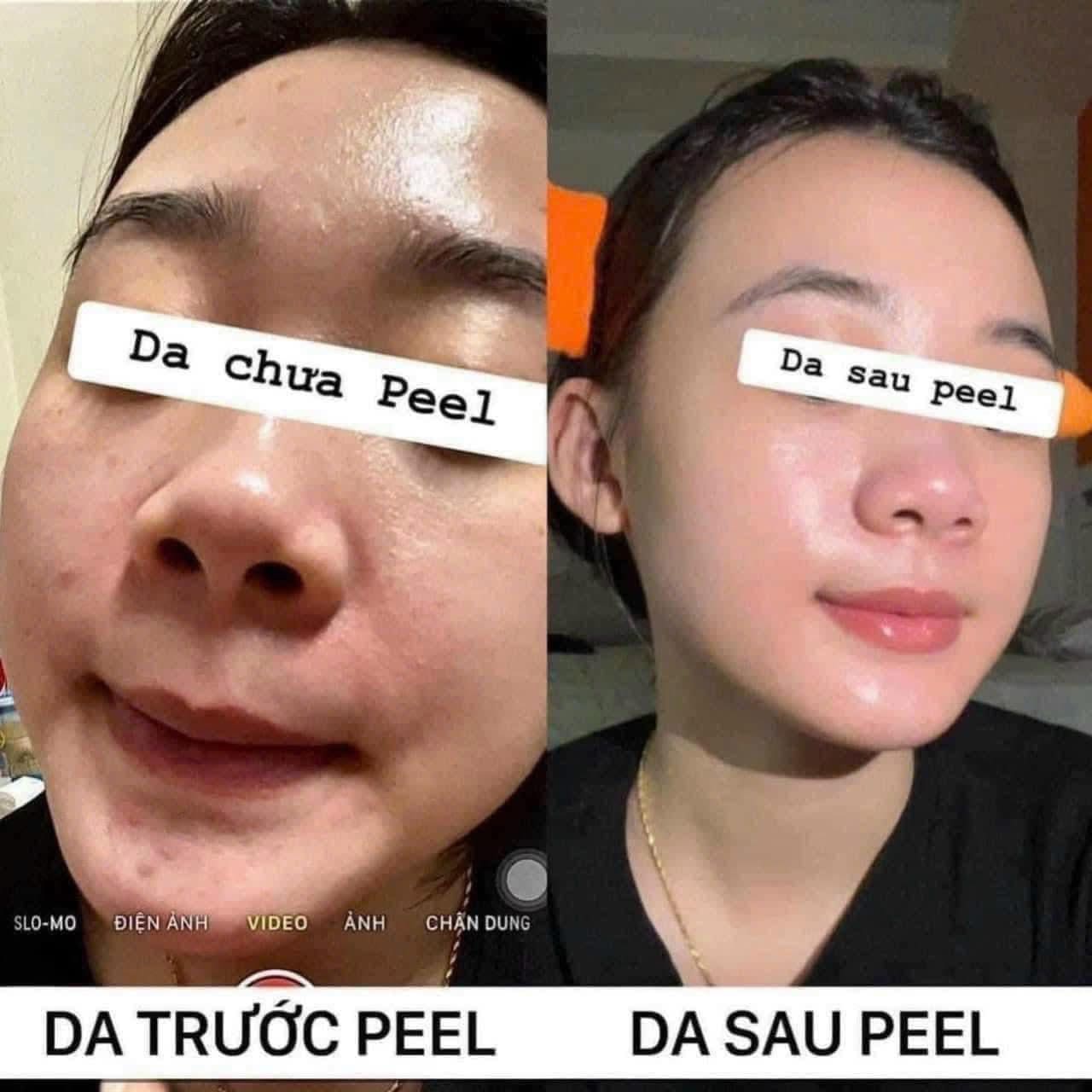 Cach-peel-da-tai-nha-an-toan-cho-nguoi-moi-bat-dau_Cách peel da tại nhà an toàn cho người mới bắt đầu 2.jpg