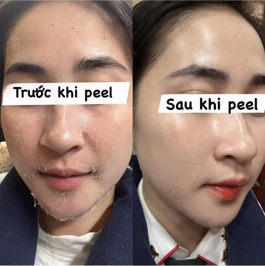 Cach-peel-da-tai-nha-an-toan-cho-nguoi-moi-bat-dau_Cách peel da tại nhà an toàn cho người mới bắt đầu.jpg