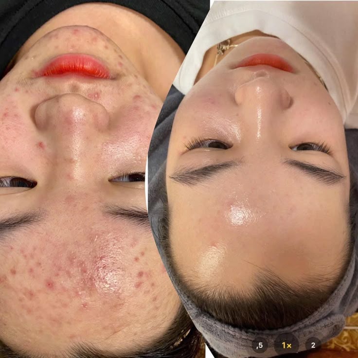 Cham-Soc-Da-Mun-Dung-Cach-Bi-Quyet-Giup-Da-Sach-Khoe-Giam-Viem-Va-Ngua-Mun-Tai-Phat_Chăm sóc da mụn-1.jpg
