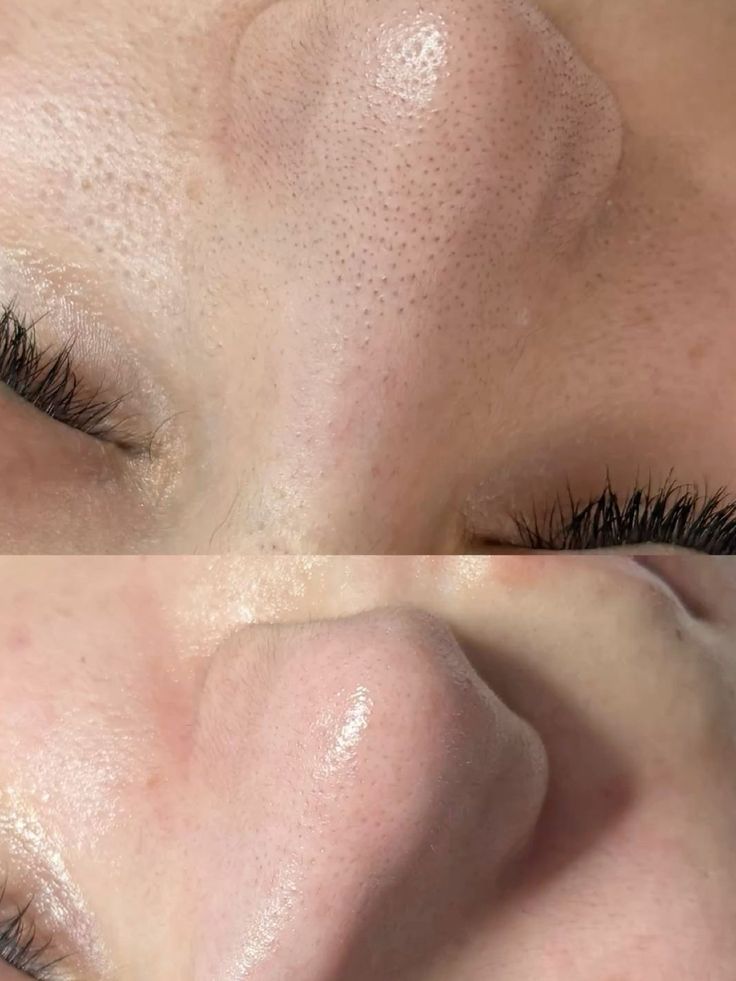 Chemical-Peel-Peel-Da-Hoa-Hoc-Giup-Tai-Tao-Da-Giam-Tham-Mo-Nam-Hieu-Qua_Chemical Peel (Peel da hóa học) 3.jpg