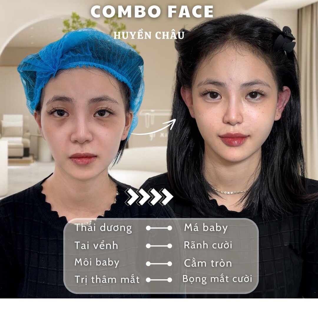 Chi Phí Cân Chỉnh Full Face Hiện Nay Bao Nhiêu?