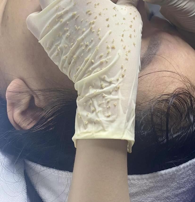 Chọn Sai Spa Lấy Nhân Mụn – Nguy Cơ Lây Nhiễm Và Sẹo Rỗ