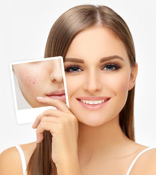 Có Nên Trang Điểm Khi Mặt Đang Bị Mụn? Cách Makeup Đúng