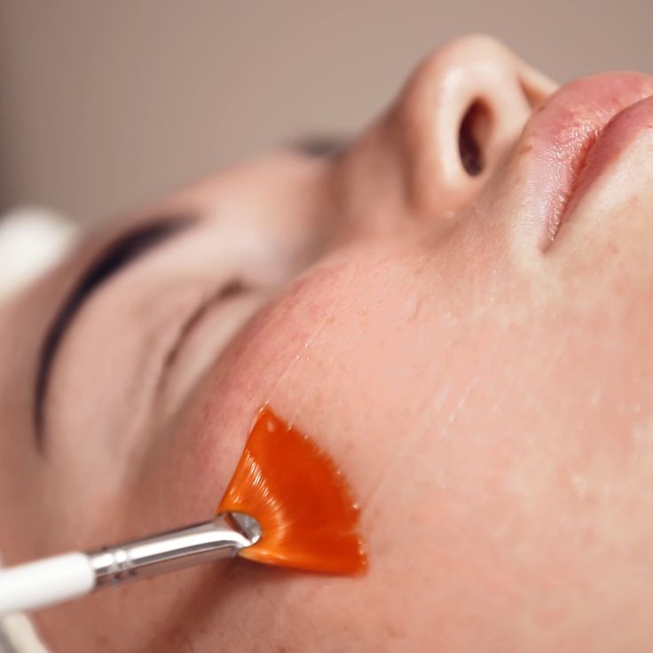Có Nên Tự Peel Da Tại Nhà Không?