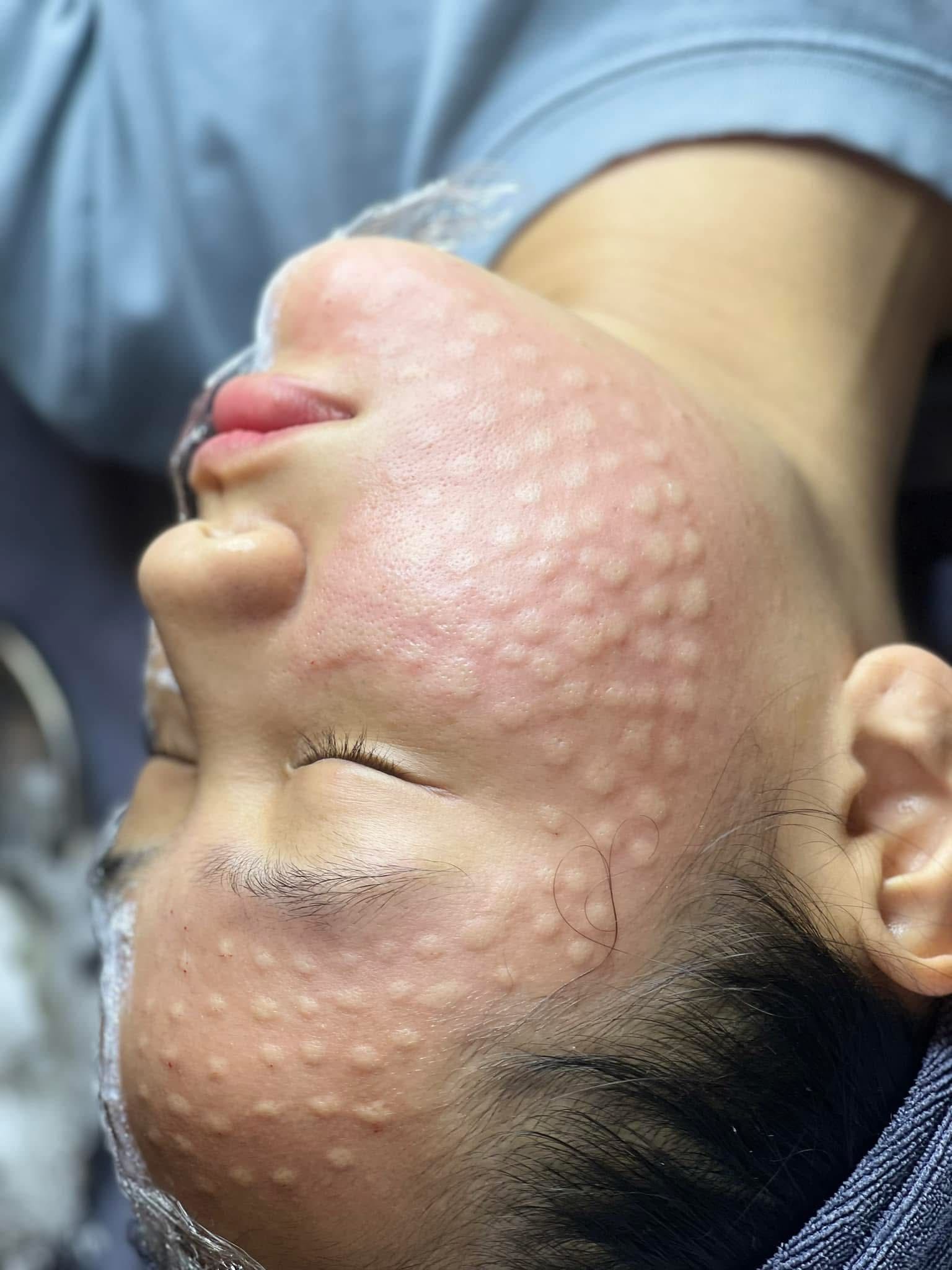 Da-Dang-Bi-Mun-Viem-Co-Tiem-Meso-Duoc-Khong-_Da Đang Bị Mụn Viêm Có Tiêm Meso Được Không (1).jpg