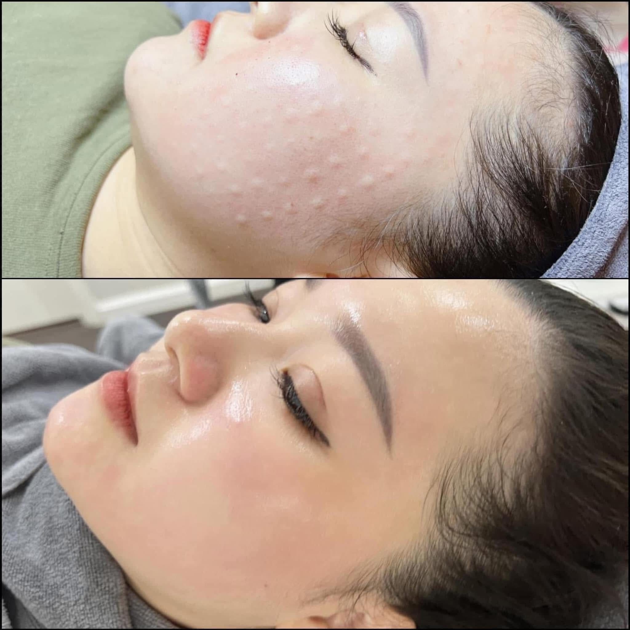 Da-Dang-Bi-Mun-Viem-Co-Tiem-Meso-Duoc-Khong-_Da Đang Bị Mụn Viêm Có Tiêm Meso Được Không 2 (1).jpg