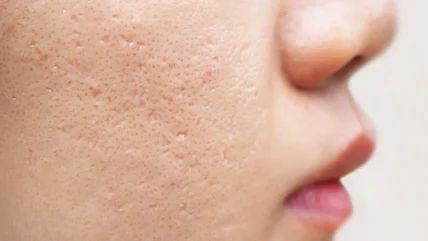 Da Dầu Có Dễ Bị Sẹo Đáy Nhọn Không?