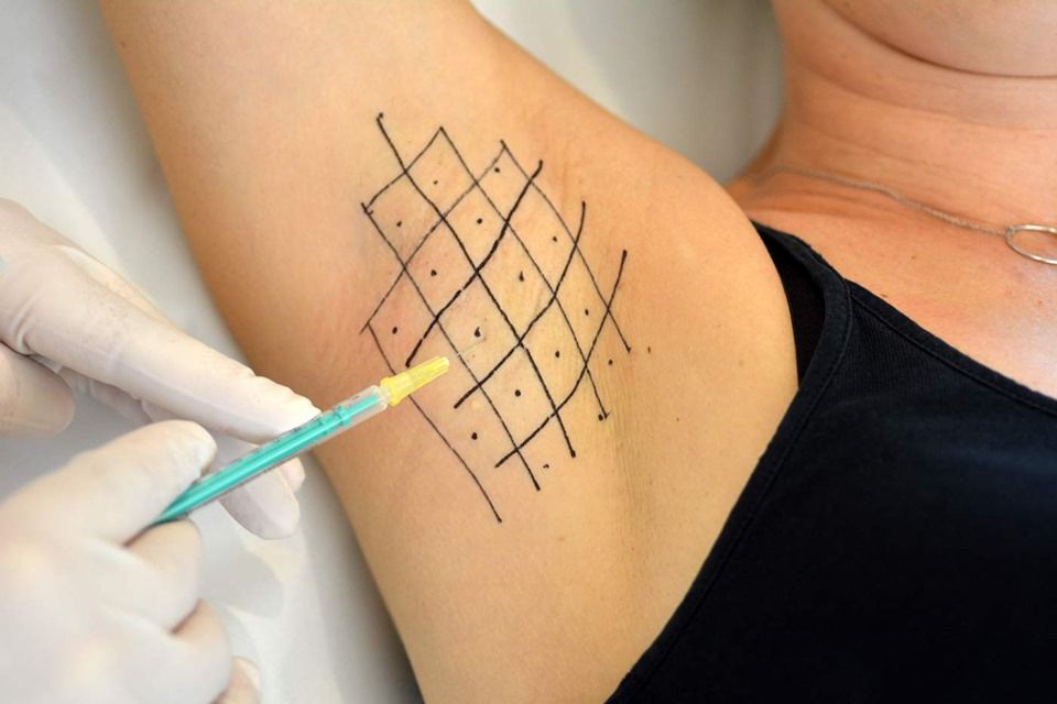 Dieu-Tri-Hoi-Nach-Bang-Botox-Tai-Spa-Clinic_Điều Trị Hôi Nách Bằng Botox Tại Spa Clinic 1.jpg