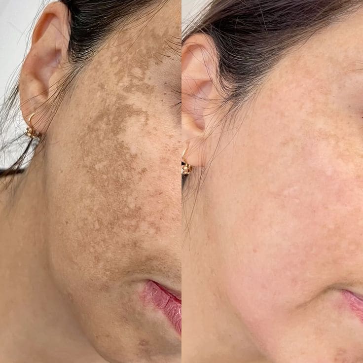 Dieu-Tri-Nam-Da-Nen-Dung-My-Pham-Uong-Vien-Hay-Laser-_Điều Trị Nám Da Nên Dùng Mỹ Phẩm, Uống Viên Hay Laser (2).jpg