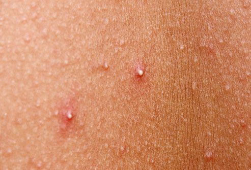Không Lấy Nhân Mụn Đúng Cách – Mụn Đầu Trắng Sẽ Nặng Hơn