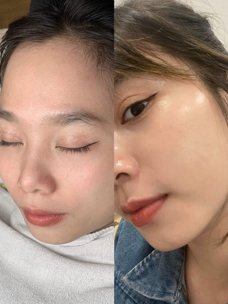 Làm Sao Để Duy Trì Hiệu Quả Sau Tiêm Meso Tại Nhà?