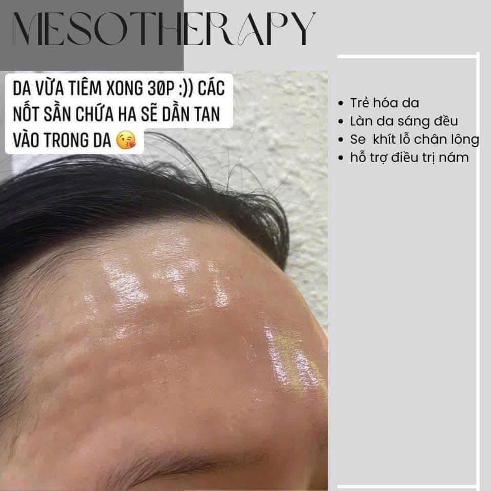 Meso-Co-Gay-Sung-Bam-Khong-Bao-Lau-Thi-Het-_Meso Có Gây Sưng, Bầm Không Bao Lâu Thì Hết (2).jpg