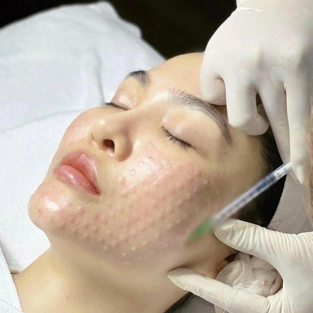 Mesotherapy-Lieu-Phap-Tiem-Duong-Chat-Trung-Bi-Giup-Phuc-Hoi-Va-Tre-Hoa-Da-Toan-Dien_Mesotherapy – Liệu Pháp Tiêm Dưỡng Chất Trung Bì Giúp Phục Hồi Và Trẻ Hóa Da Toàn Diện.jpg
