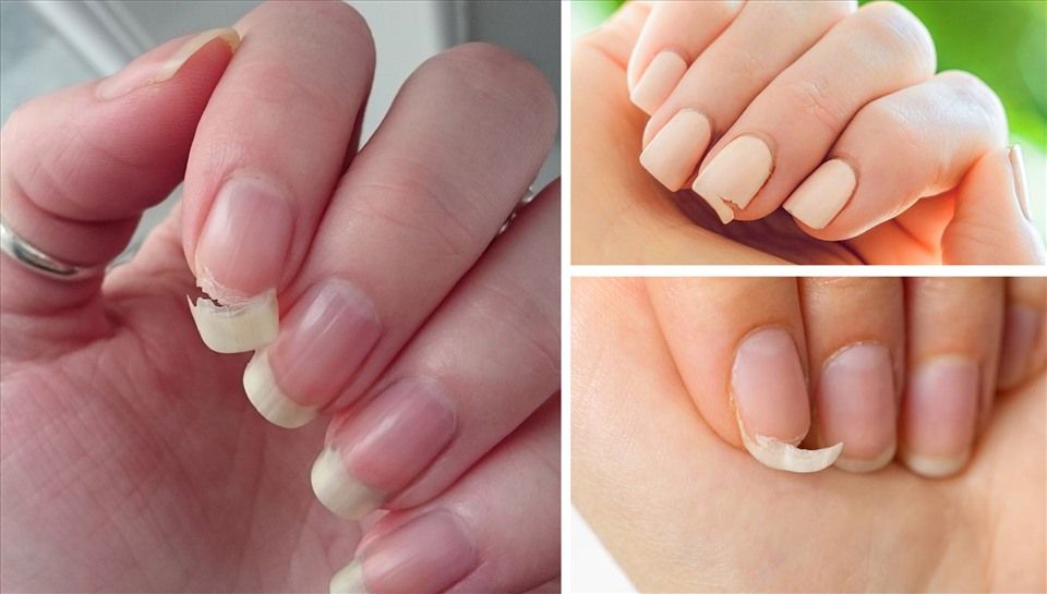 Móng Tay Yếu Và Dễ Gãy: Nguyên Nhân Và Cách Khắc Phục