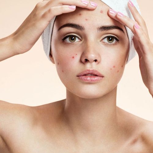 Mụn Áp Xe Là Gì? Nguyên Nhân & Cách Điều Trị Chuẩn Y Khoa