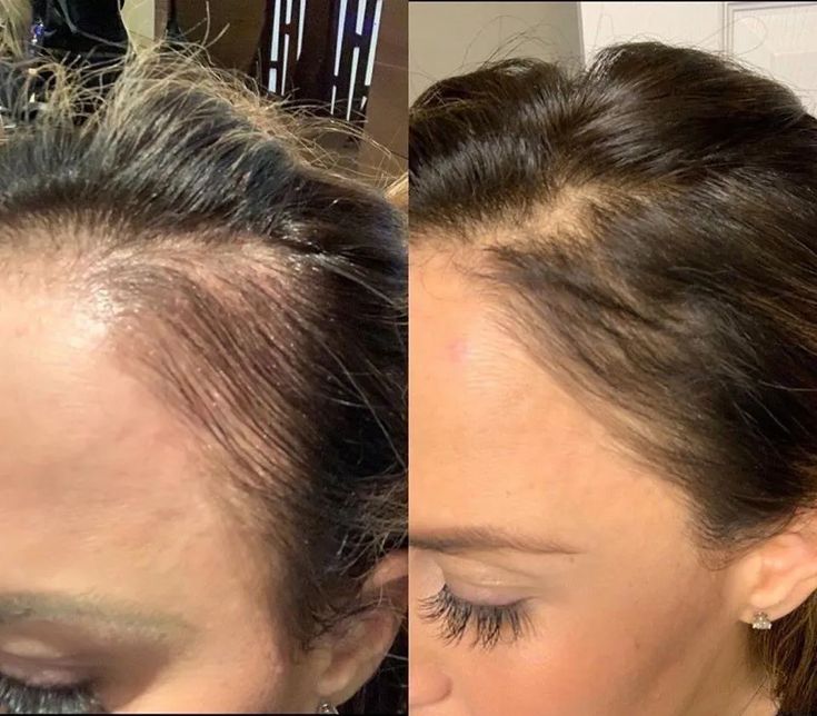 Rụng tóc có nên tiêm Meso không?