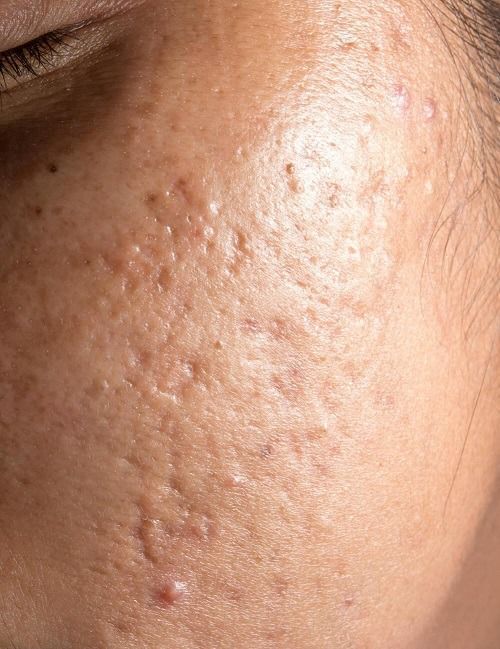 Sẹo Rỗ Nặng Có Trị Được Không?