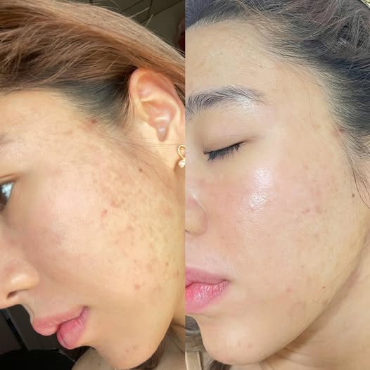 Su-That-Ve-Tham-Mun-It-Ai-Noi_Sự Thật Về Thâm Mụn Ít Ai Nói 1.jpg