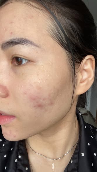 Su-That-Ve-Tham-Mun-It-Ai-Noi_Sự Thật Về Thâm Mụn Ít Ai Nói.jpg