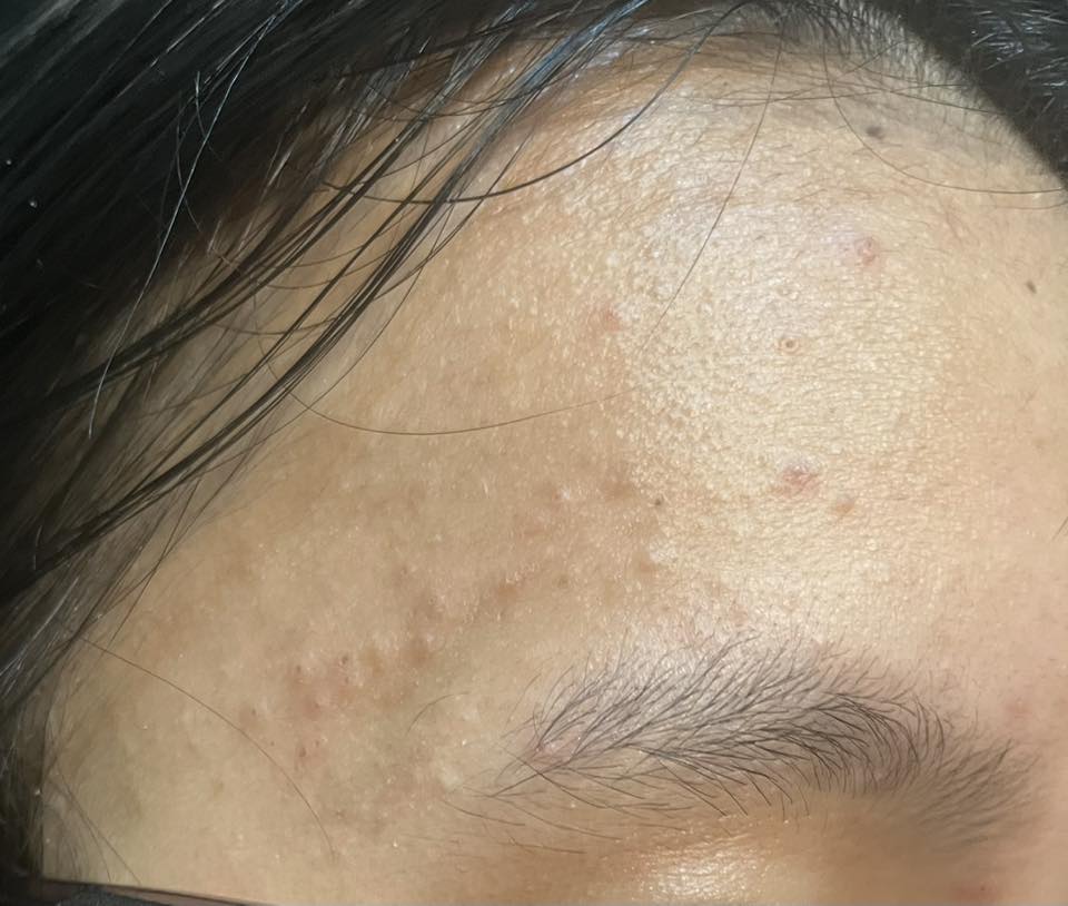 Tại sao trị mụn ẩn mãi không hết?