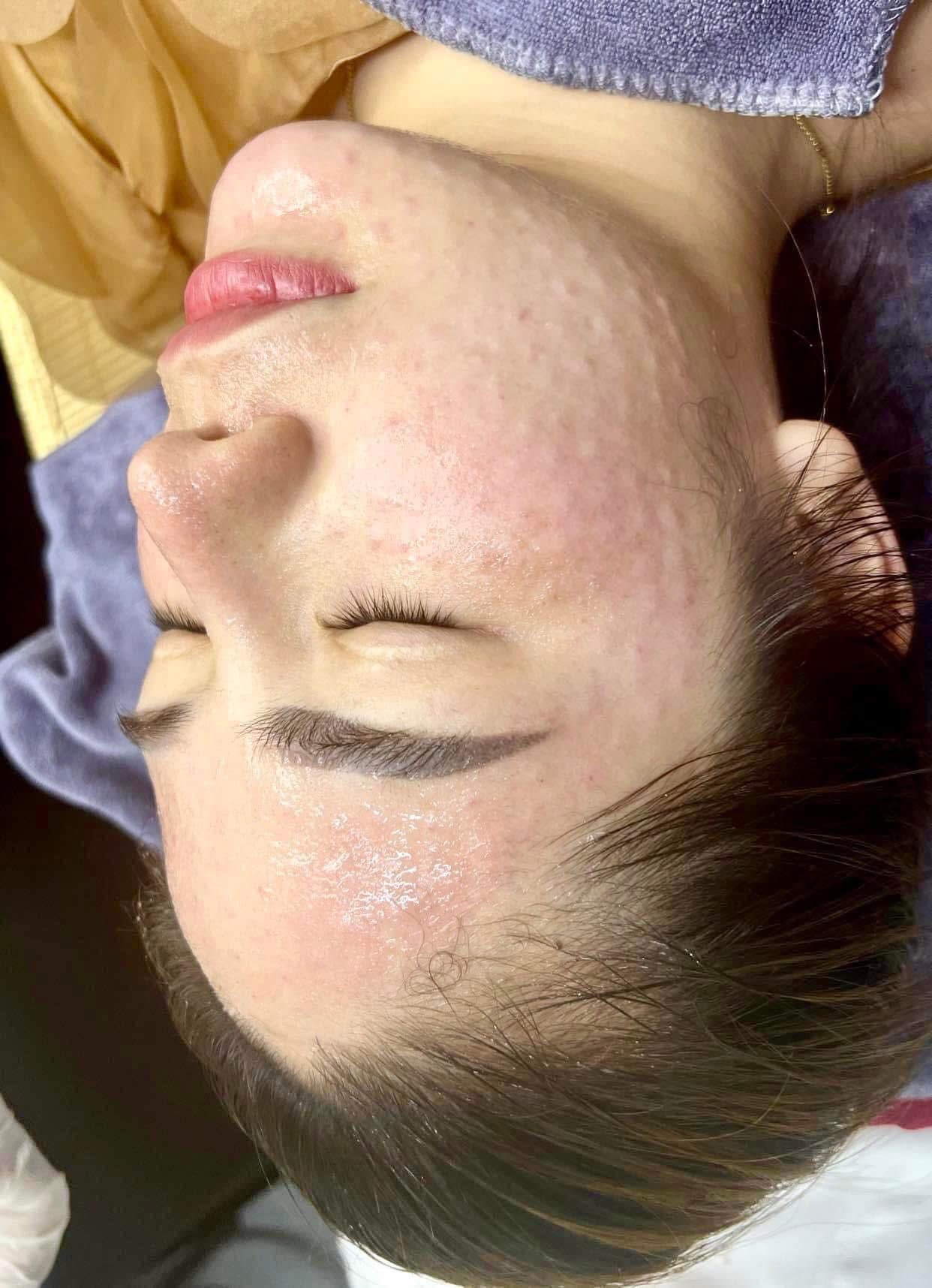 Tiem-Meso-Don-Tet-Hieu-Qua-Bao-Lau-Can-Lam-Truoc-Tet-Bao-Nhieu-Tuan-_Tiêm Meso-1.jpg