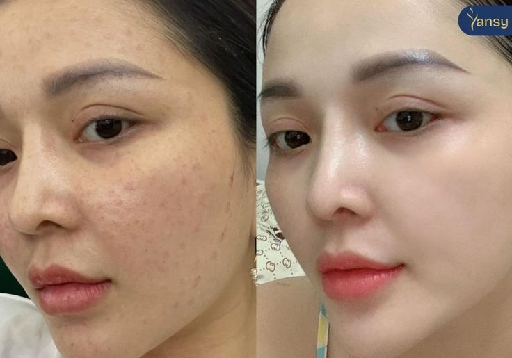 Tiêm Mesotherapy Tại Nhà Có Bị Nhiễm Trùng Không?