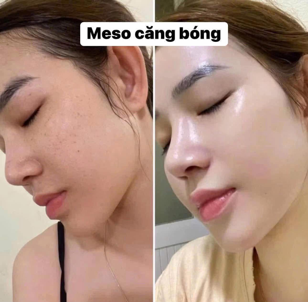 Trải Nghiệm Thực Tế Khi Làm Meso Căng Bóng Da