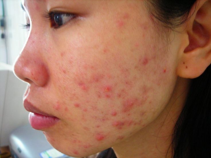 Tri-Mun-An-Sai-Cach-Khien-Da-Bung-Viem-1.jpg