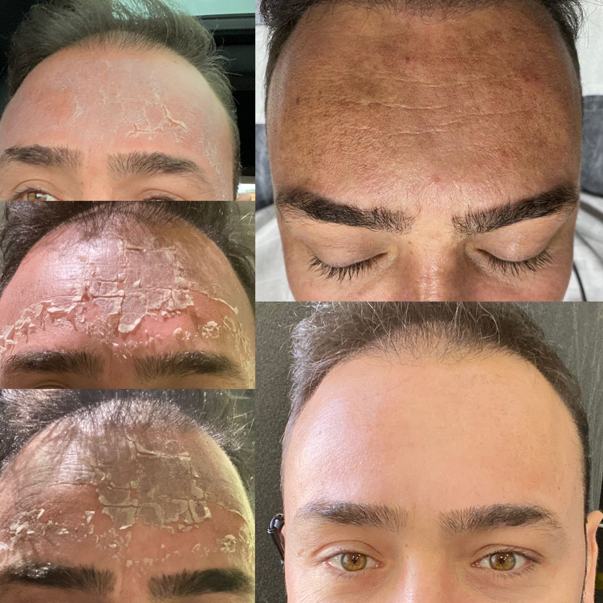 Tri-Tham-Mun-Bang-Peel-Da-Co-Hieu-Qua-Khong-_Trị Thâm Mụn Bằng Peel Da Có Hiệu Quả Không 1.jpg