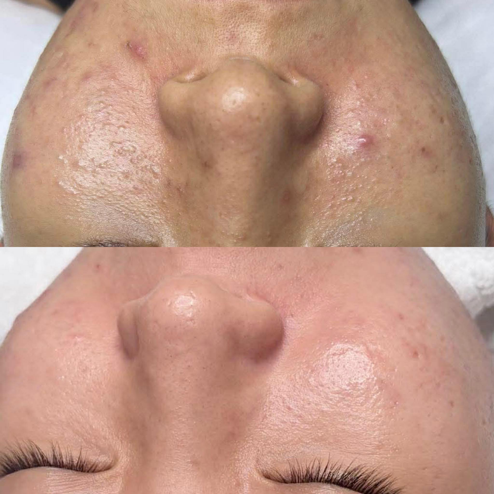 Trị mụn spa có hiệu quả không? Kinh nghiệm thật